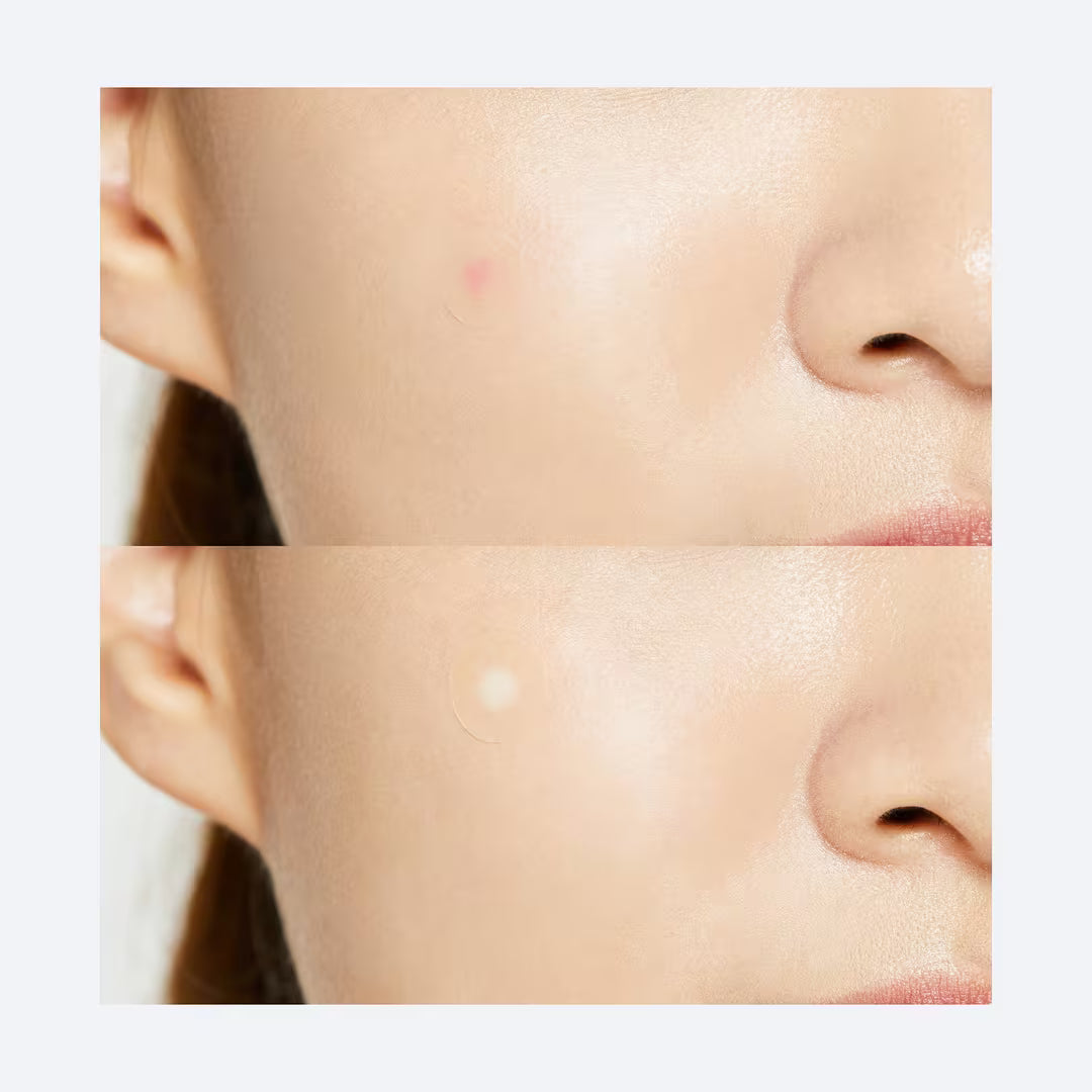 Acne Pimple Master (24ea)